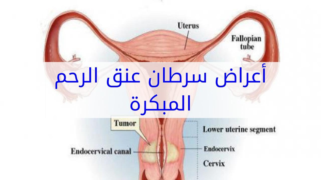 اعراض سرطان الرحم - كيفيه التعرف على مرض سرطان الرحم 2123 3