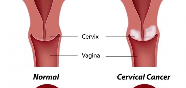 اعراض سرطان الرحم - كيفيه التعرف على مرض سرطان الرحم 2123 1