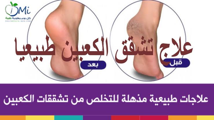 علاج تشقق الكعبين - و صفة ممتزه التخلص من تشقق الكعبين 6310 2