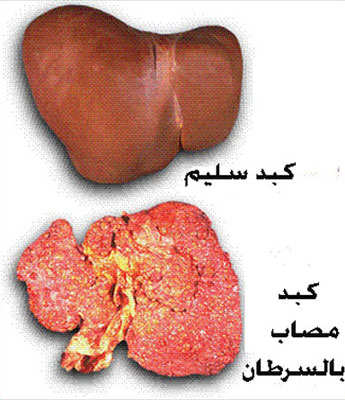 اعراض سرطان الكبد الاخيرة - كيف تعرف انك في المراحل الاخيرة من سرطان الكبد 3519 2