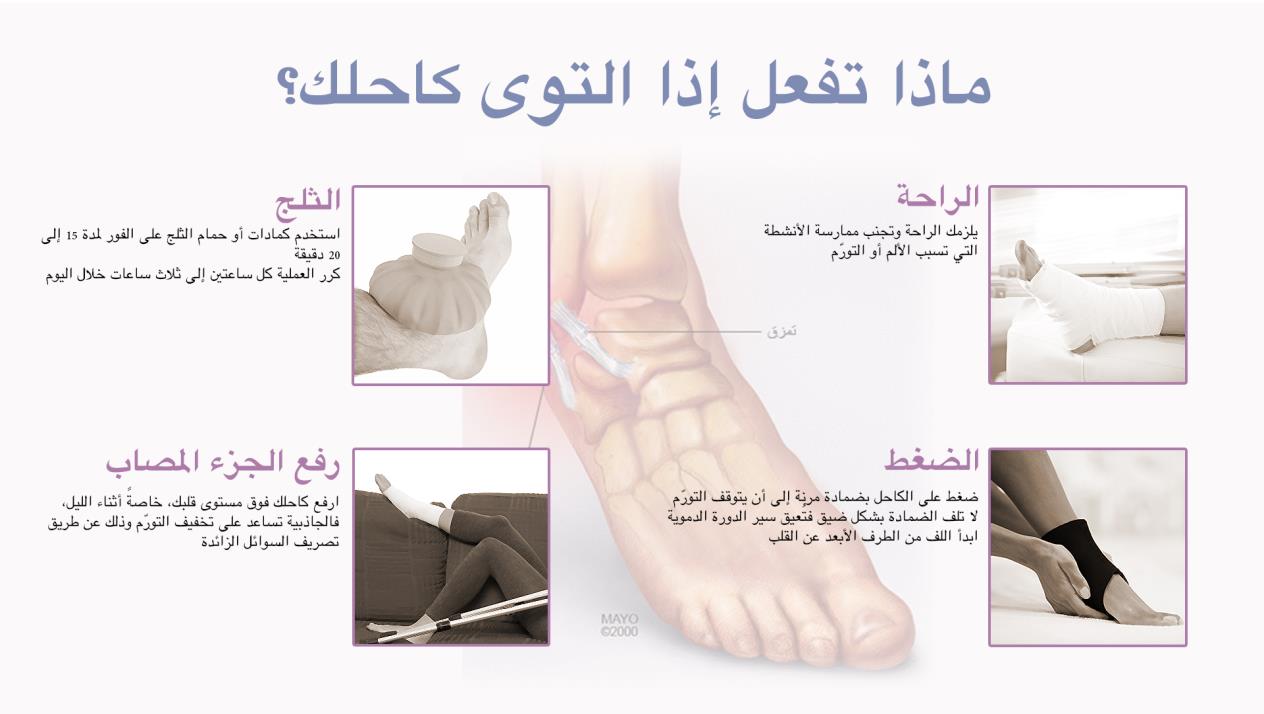 علاج التواء الكاحل بالصور