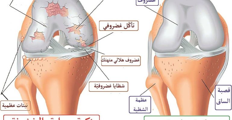 علاج خشونه الركبه