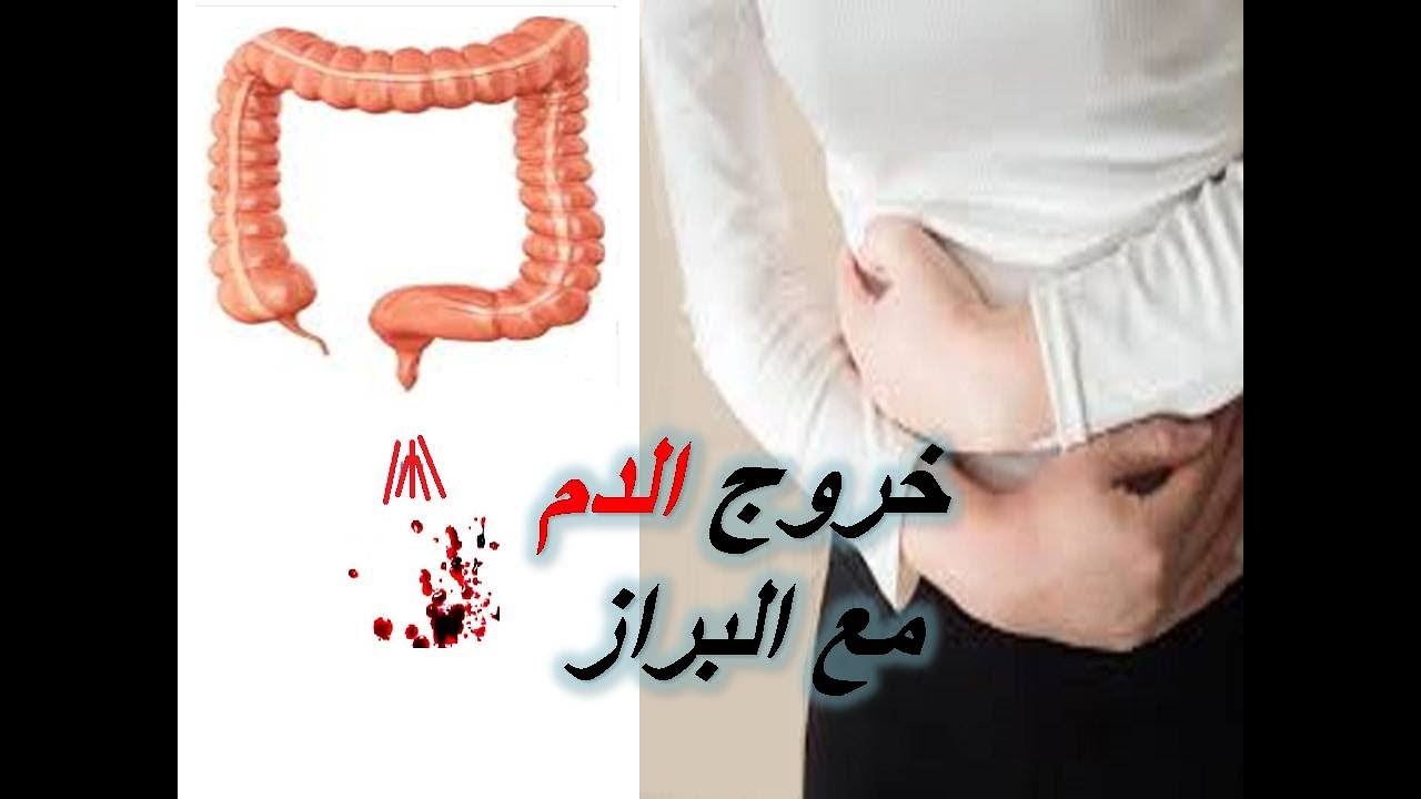 خروج دم مع البراز - تعرف علي اسباب نزول دم بالبراز وعلاجه 2638 1