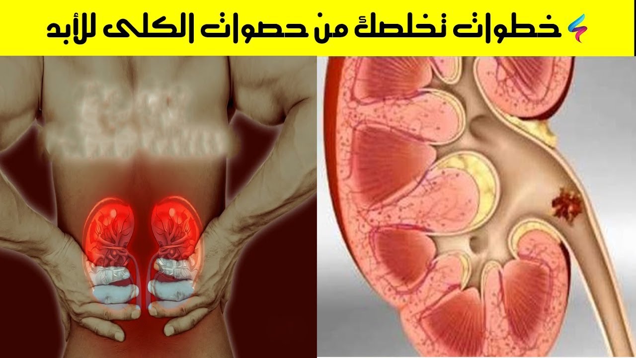 علاج طبيعي لحصى الكلى , ازاي ممكن نستخدم الطب البديل لعلاج الكلي