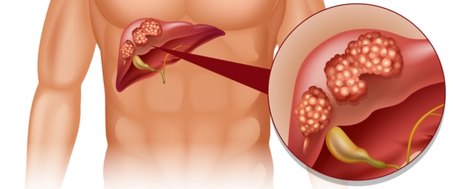 علاج سرطان الكبد بالاعشاب , سرطان الكبد و علاجه بالاعشاب