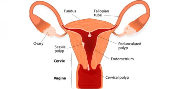 ظهور قطعة لحم في المهبل - تعرف علي اسباب وعلاج سقوط المهبل 2606 3