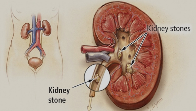 علاج املاح الكلى , حصوات الكلى