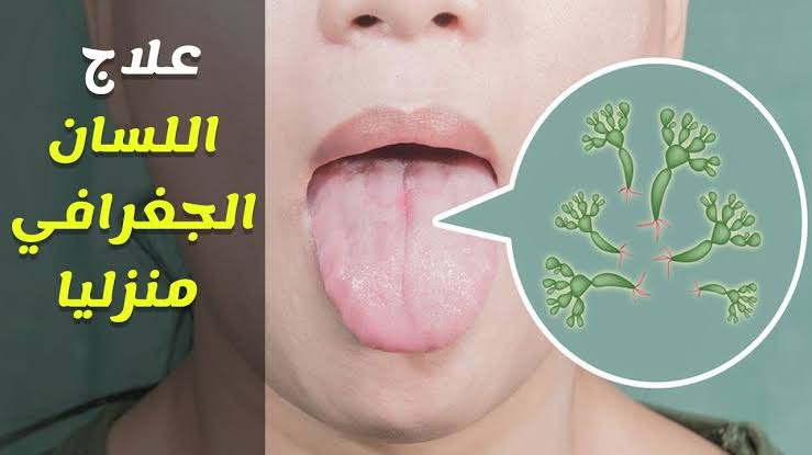 علاج اللسان المتشقق , وصفة سهلة ومن البيت