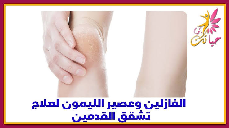 علاج تشقق الكعبين - و صفة ممتزه التخلص من تشقق الكعبين