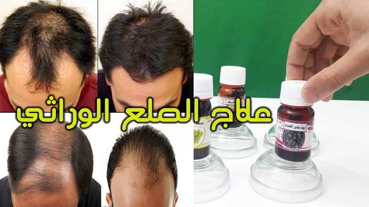 علاج الصلع بالاعشاب - و صفة ممتازه لتخلص من الصلع 6332 8